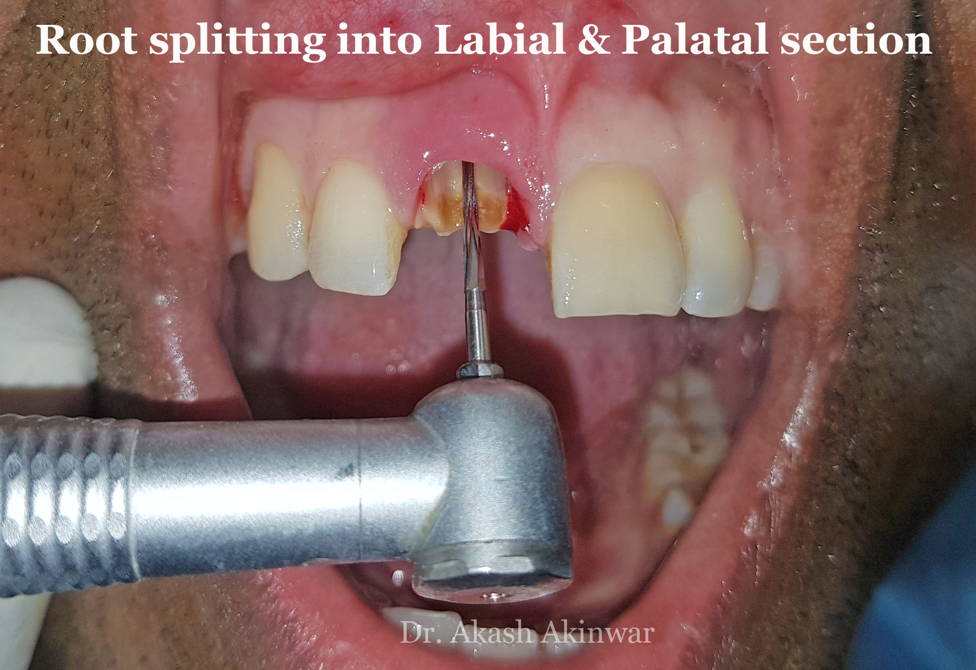Immediate Implant Placement with Socket Shield Technique followed by