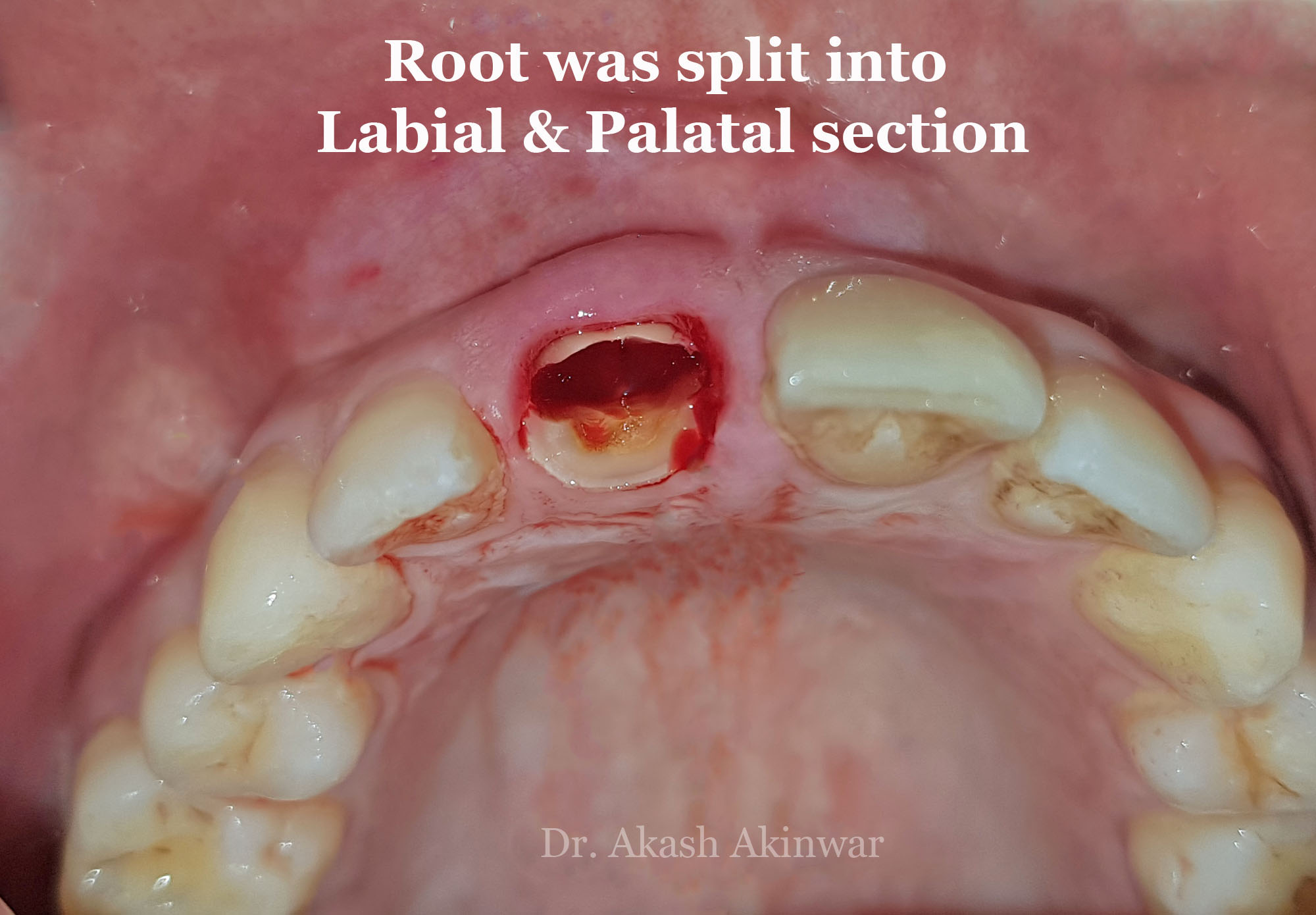 Immediate Implant Placement with Socket Shield Technique followed by