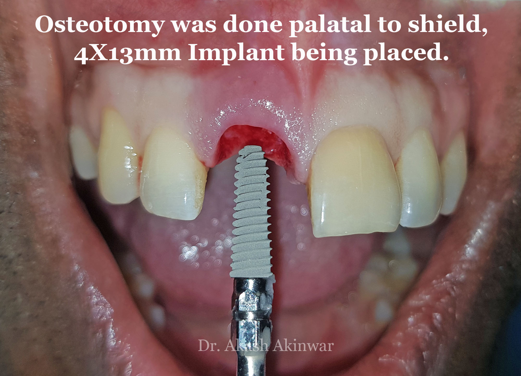 Immediate Implant Placement with Socket Shield Technique followed by