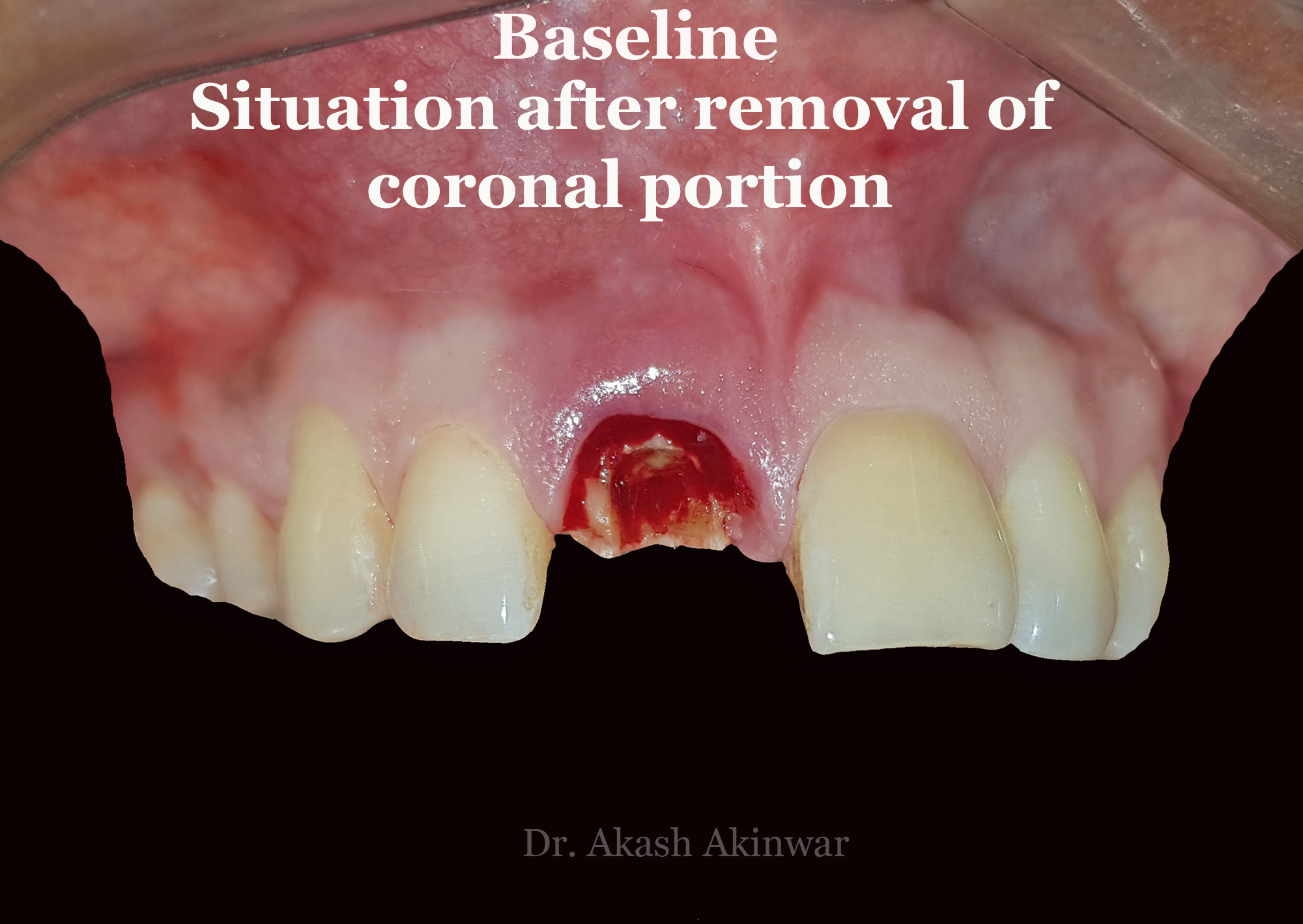Immediate Implant Placement with Socket Shield Technique followed by