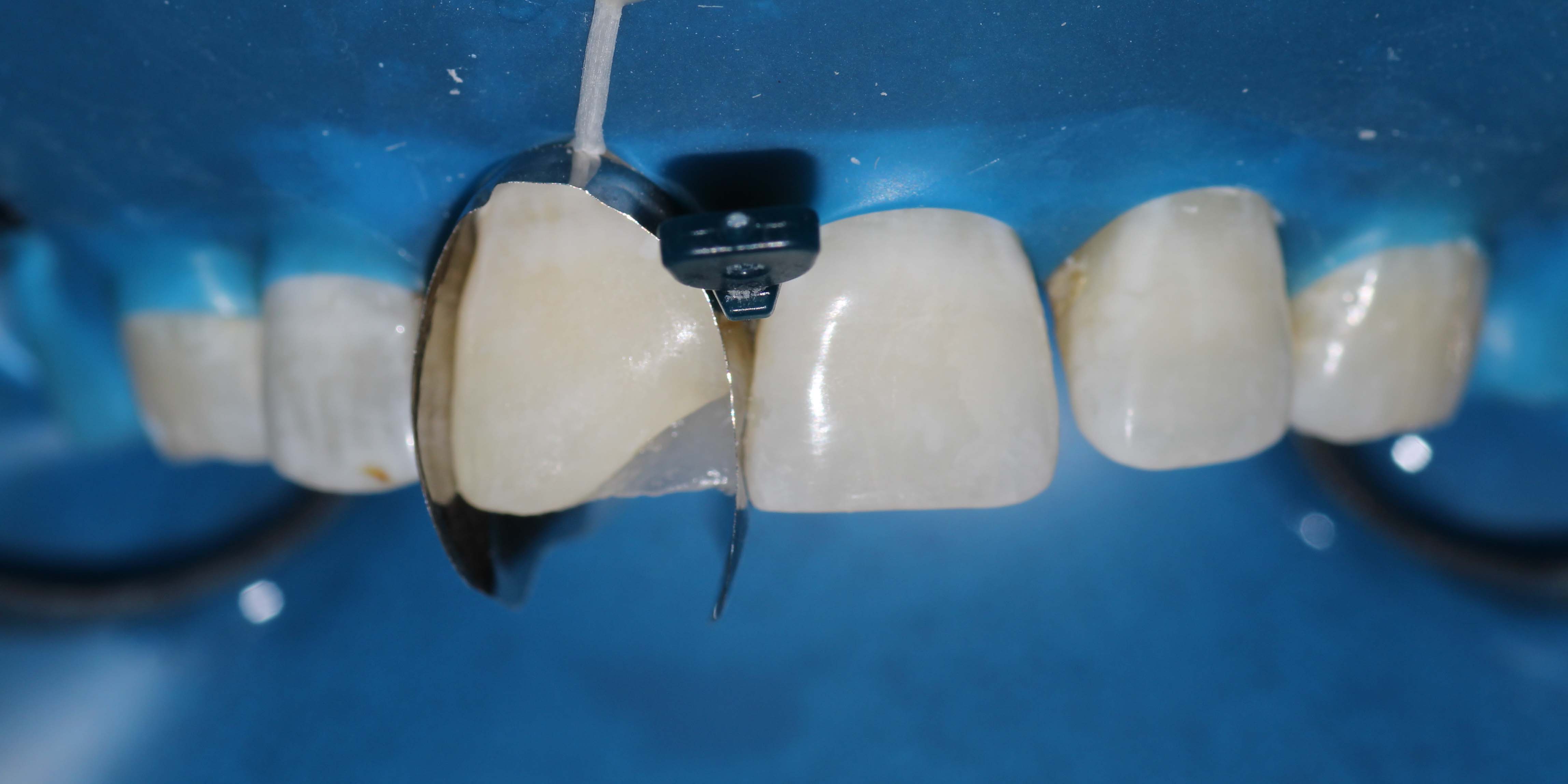 Developing tight proximal contacts in anterior teeth using Unica Anterior matrix A case report