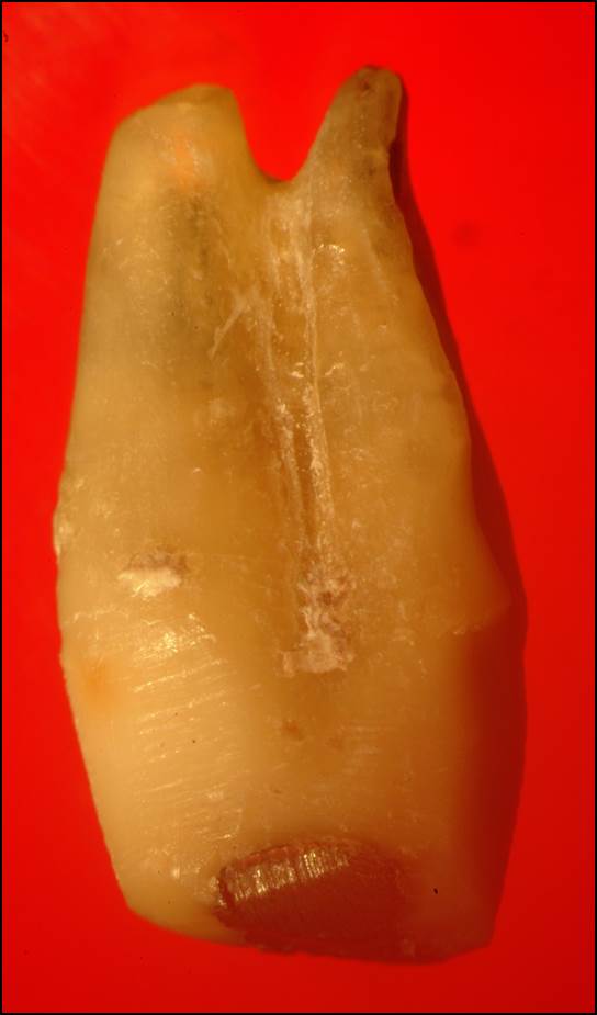 Buccal root of the bifurcated maxillary premolar—a danger zone during