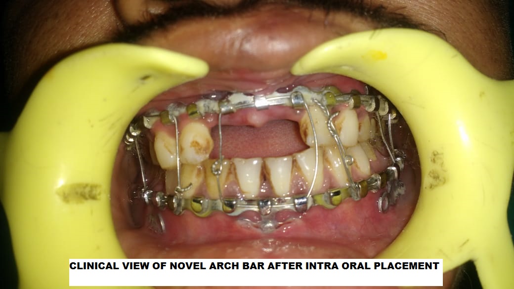 "Novel Arch Bar" patent by Dr. Soumendu Karak, OMFS