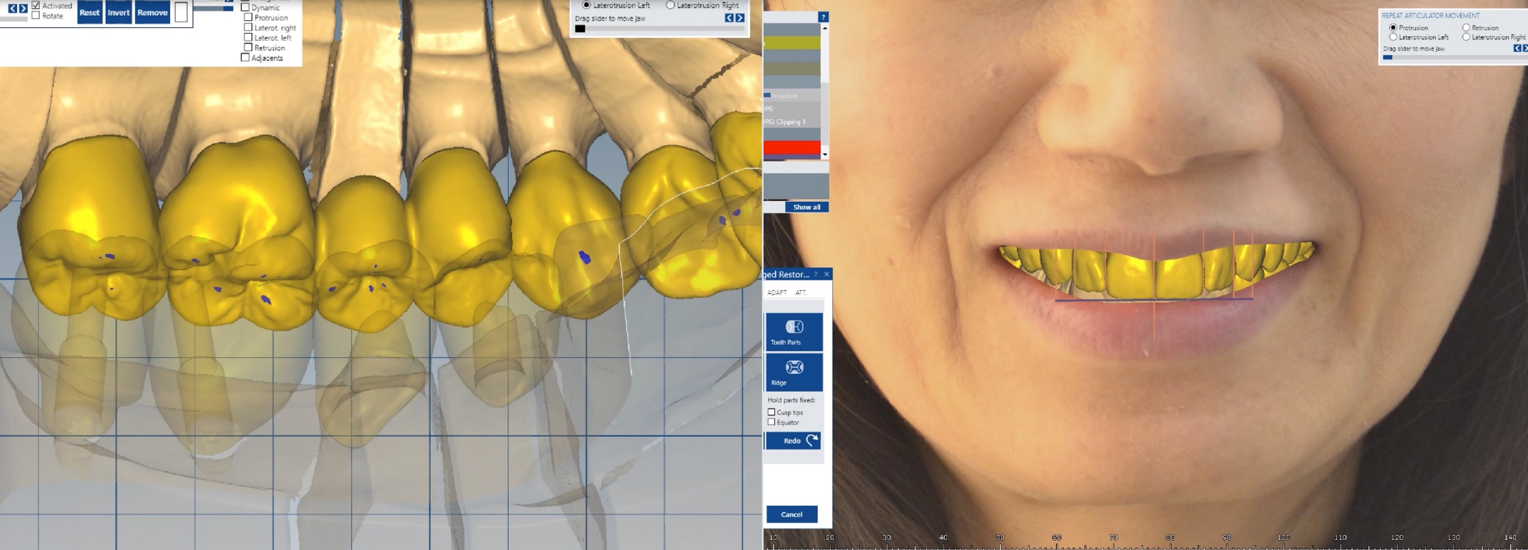 Figs. 5a & b: 2D and 3D images, combined with the design, are the perfect base for recreating the patient situation. 