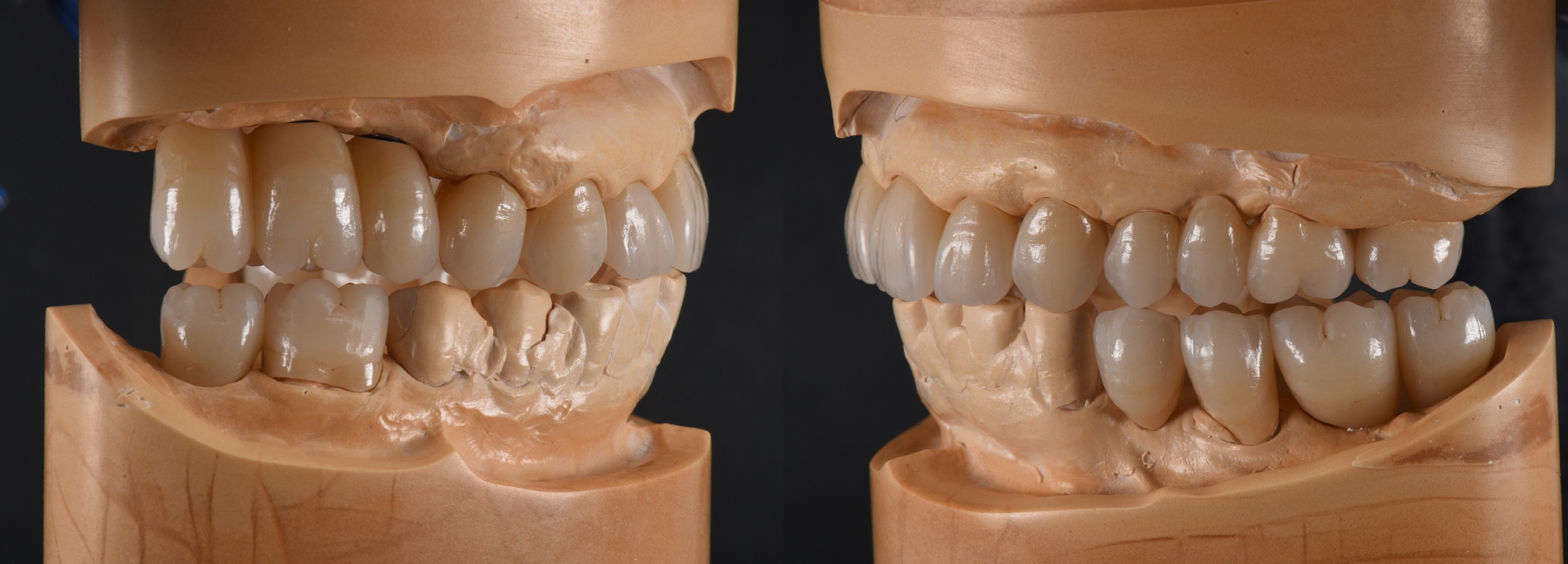 Figs. 9a & b: The perfect occlusal surfaces and canine guidance control during jaw movement.