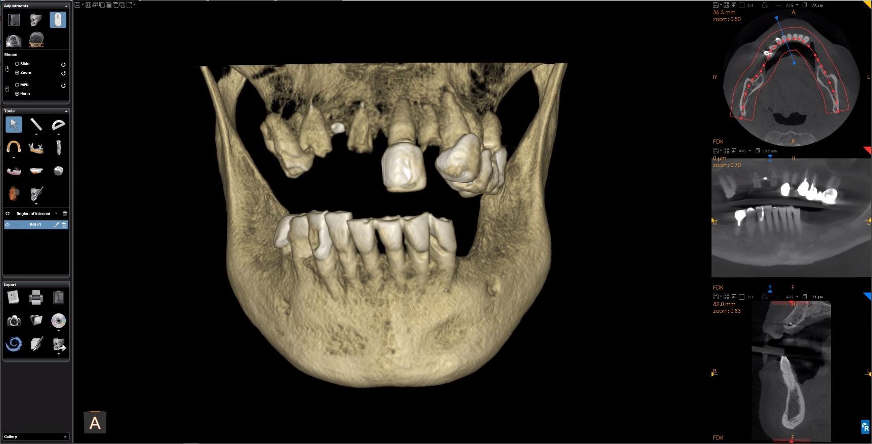 Fig. 1: CBCT imaging showing volumetric reconstruction, axial, panoramic and sagittal views.