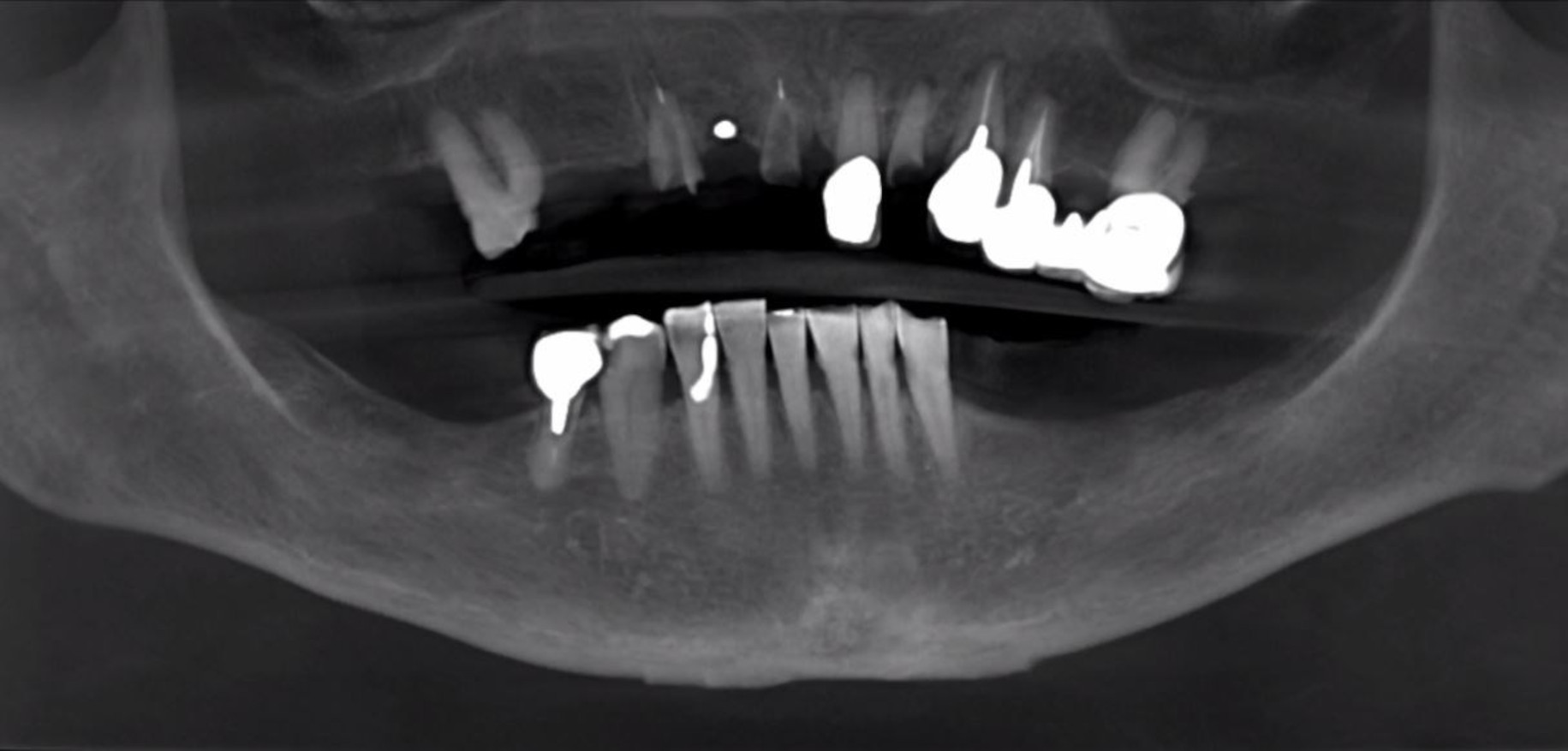 Fig. 2: Panoramic reconstructed view revealing fractured teeth, residual root tips and failing dentition.