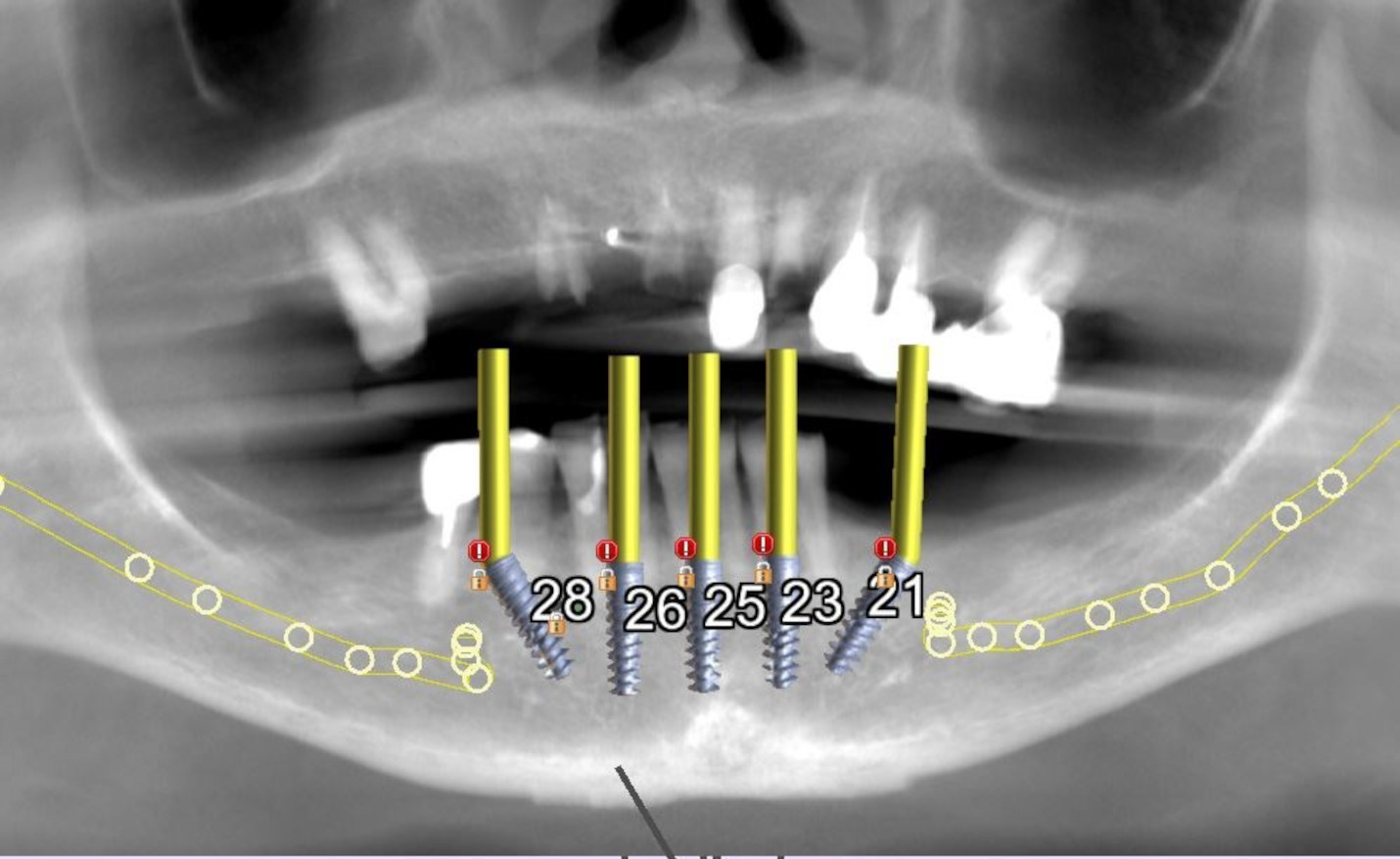Fig. 3b: Five simulated implants with two tilted to avoid the inferior alveolar nerves in the mandibular arch.