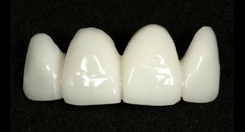 Fig. 10: First PMMA prototype for teeth #12–22 based on the original digital proposal that was a bio-copy of the patient’s original maxillary restorations.