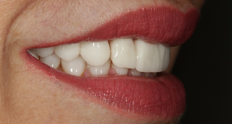 Fig. 18: Right lateral view of the patient’s smile, showing the facial surface texture of the PMMA prototype and the incisal plane nicely following the contour of the lower lip. Note the beautiful aesthetic textures of these prototype restorations.
