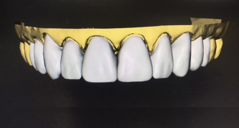 Fig. 4: Original digital proposal for the case based on the patient’s previous restorations.
