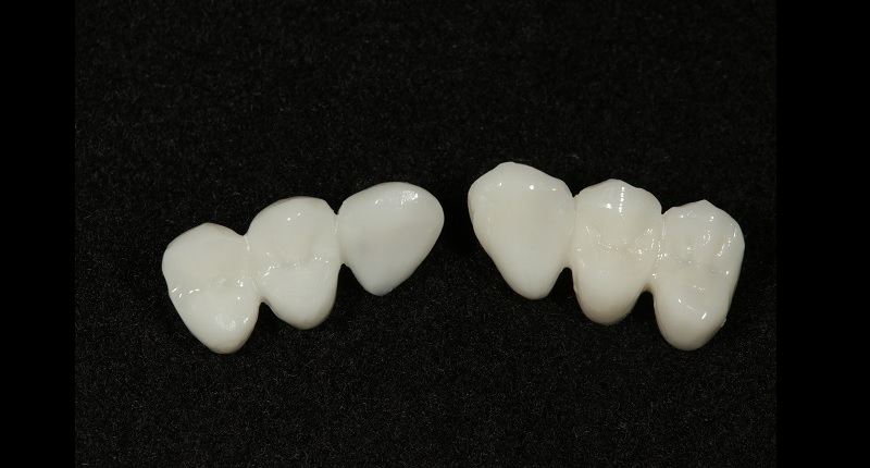 Fig. 8: Occlusal view of the posterior segments (teeth #15–13 and teeth #23–25) of the original digital proposal milled in PMMA for intra-oral evaluation.