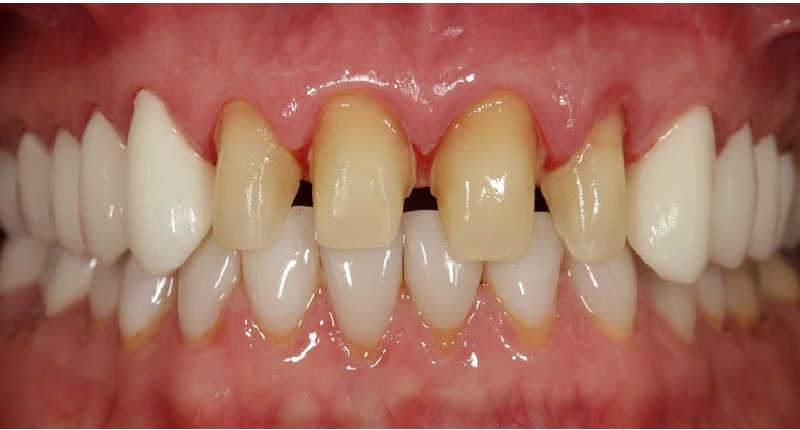 Fig. 9: Posterior PMMA prototypes in place with provisional cement and prepared teeth #12–22 after removal of the provisional restorations in preparation for evaluation of the anterior proposed aesthetic designs.